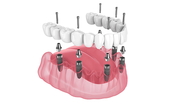 複数本数埋入によるインプラント設計