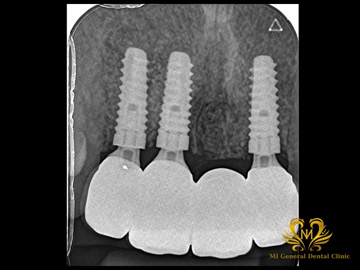 前歯の多数歯欠損のインプラント症例