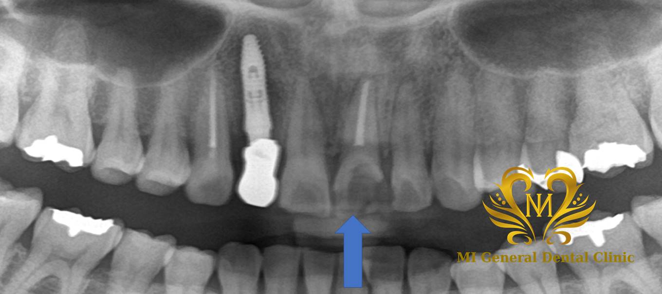 左上の前歯の抜歯即時インプラント症例