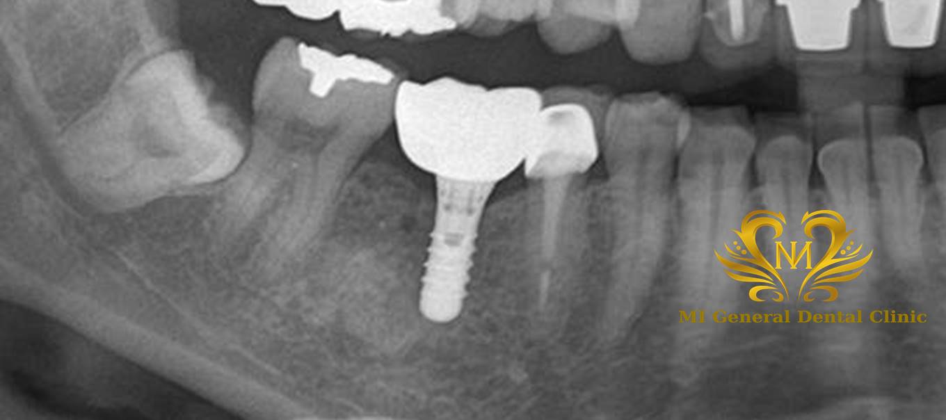 奥歯のインプラント治療