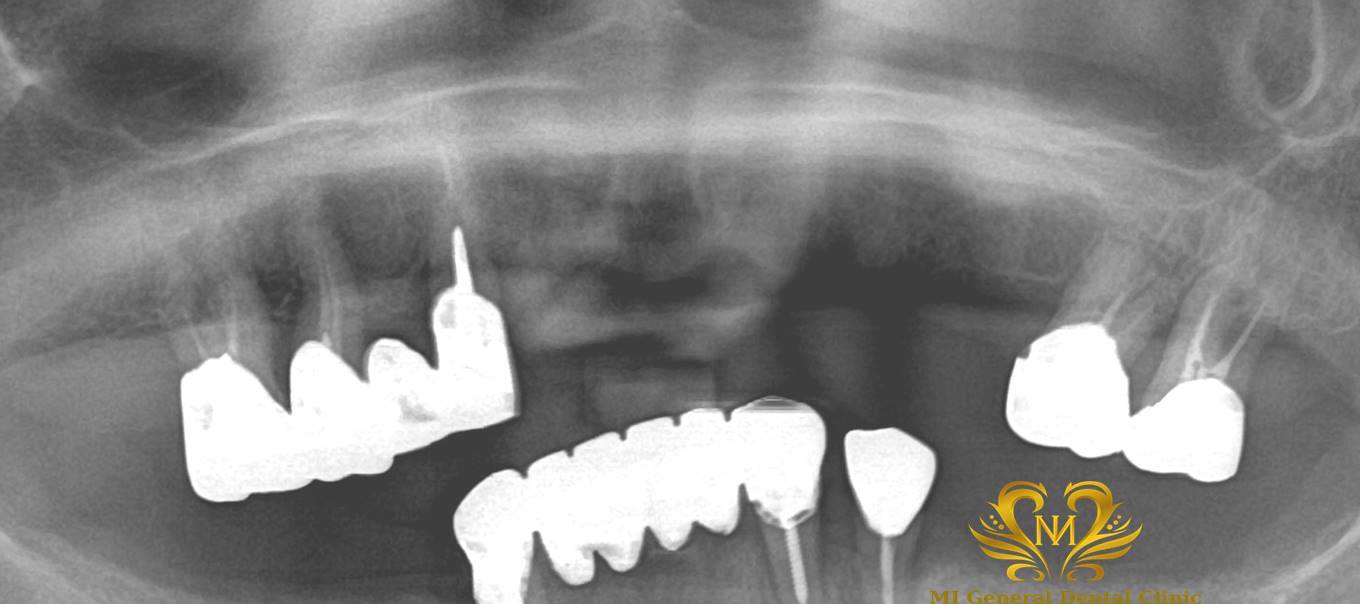 上顎前歯のインプラント（ブリッジ）