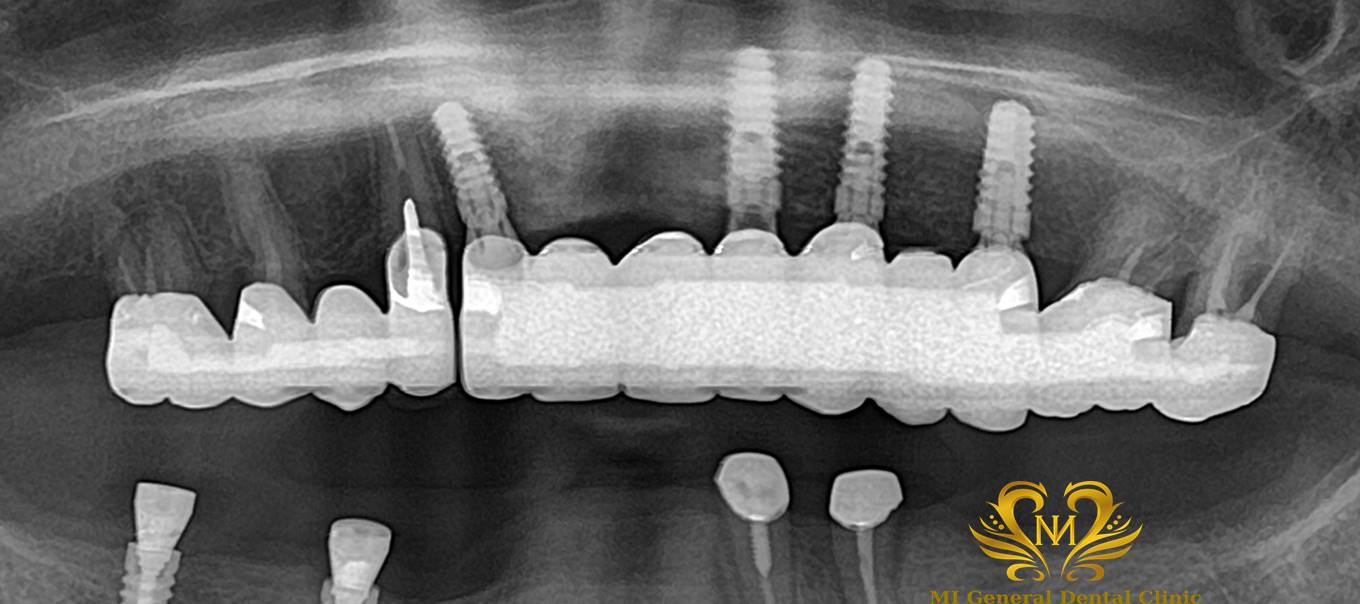 上顎前歯のインプラント（ブリッジ）