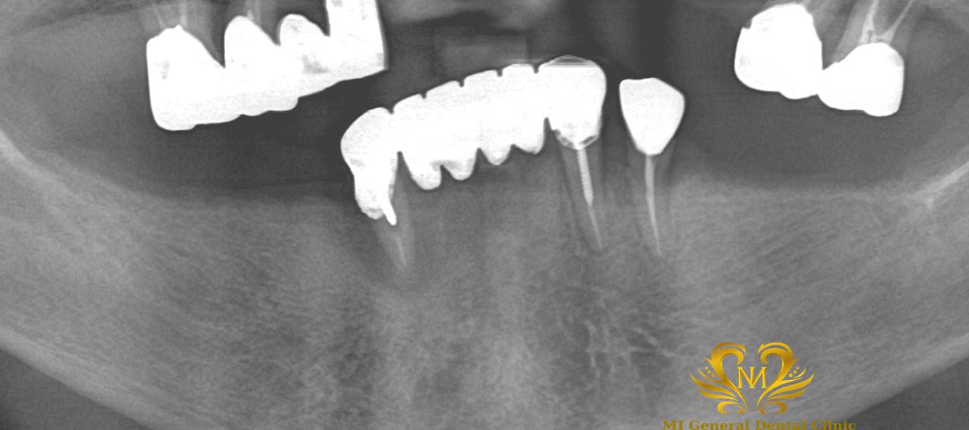 下顎オーバーデンチャー（マグネット）