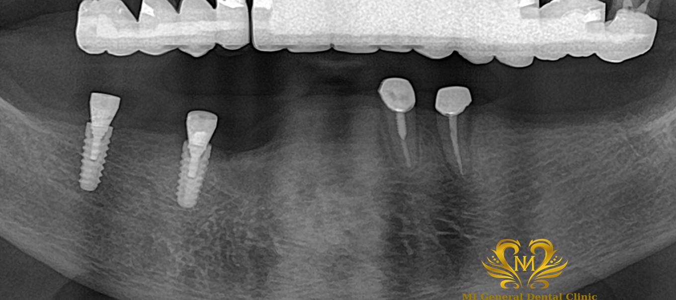 下顎オーバーデンチャー（マグネット）
