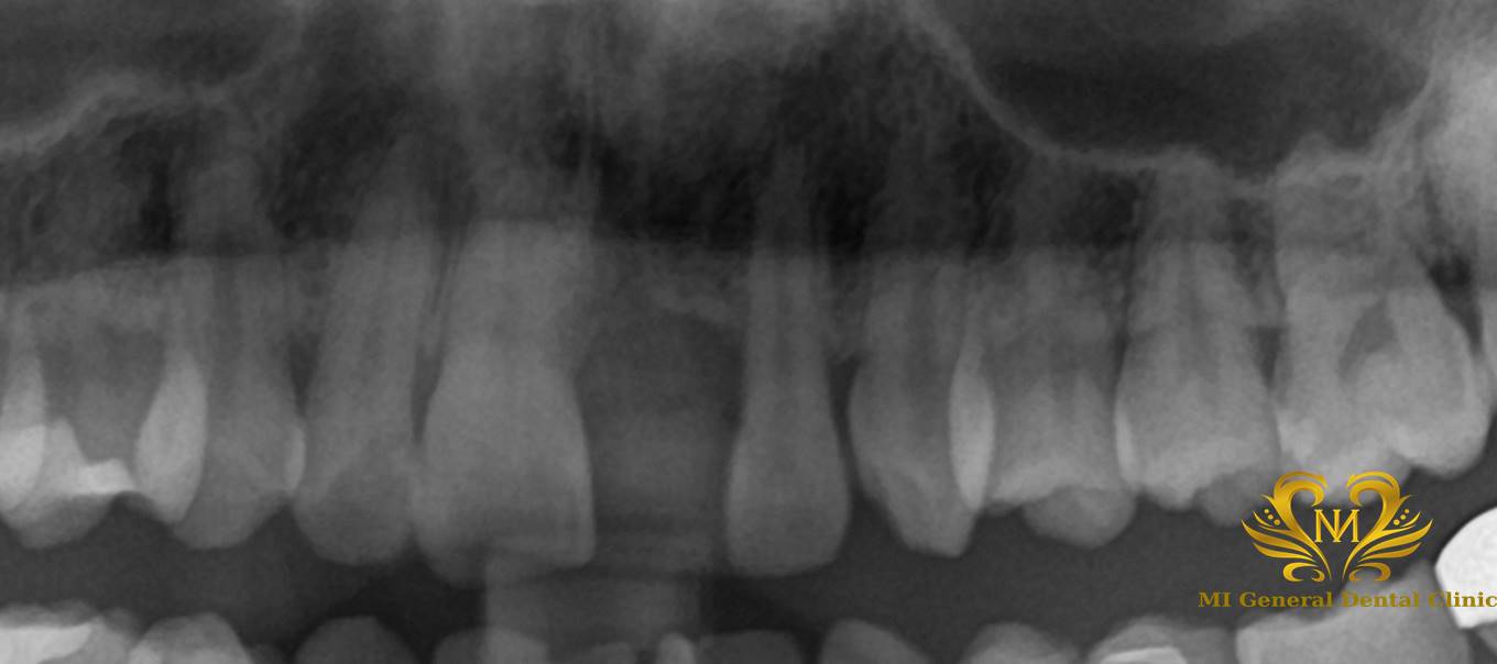 前歯のインプラント治療