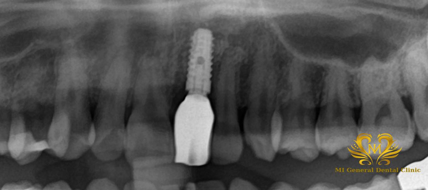 前歯のインプラント治療