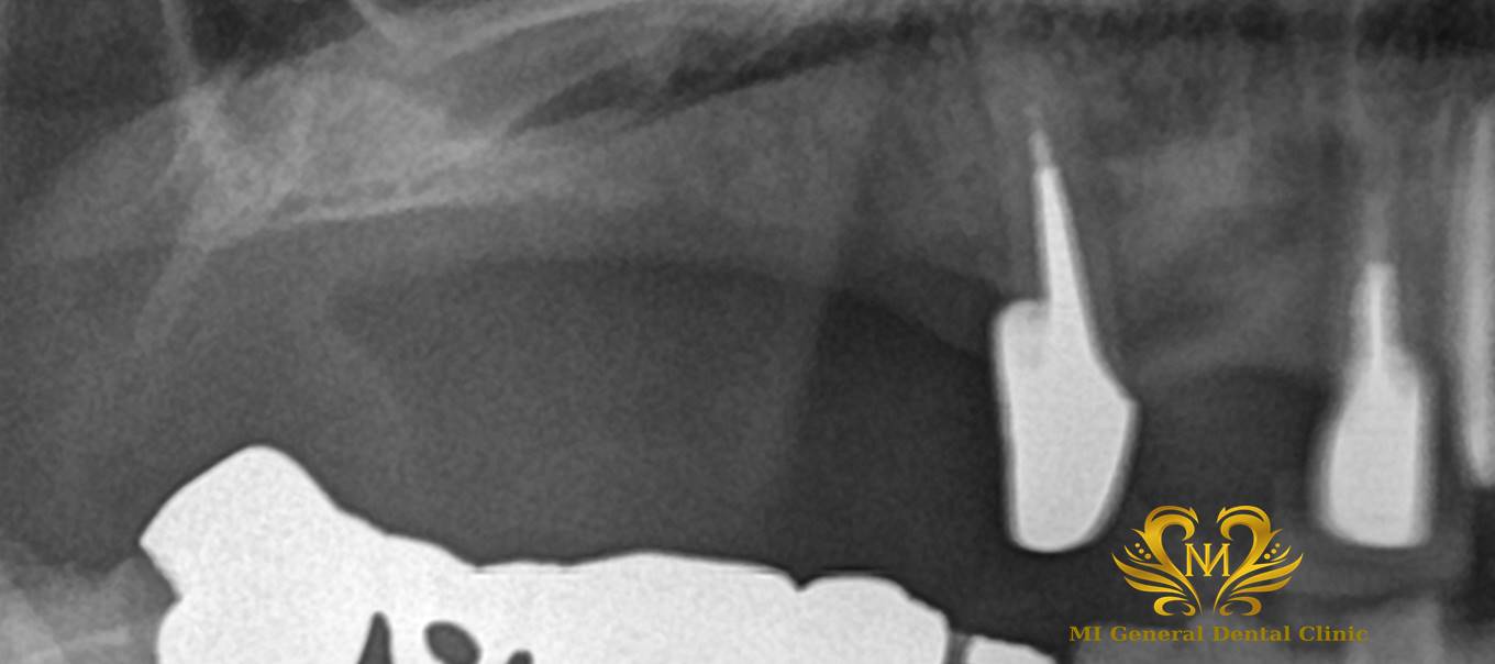 右上奥歯のインプラント治療