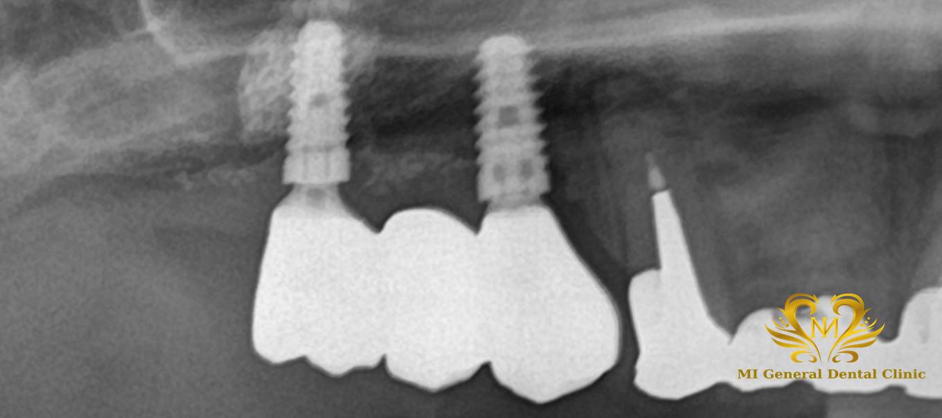 右上奥歯のインプラント治療