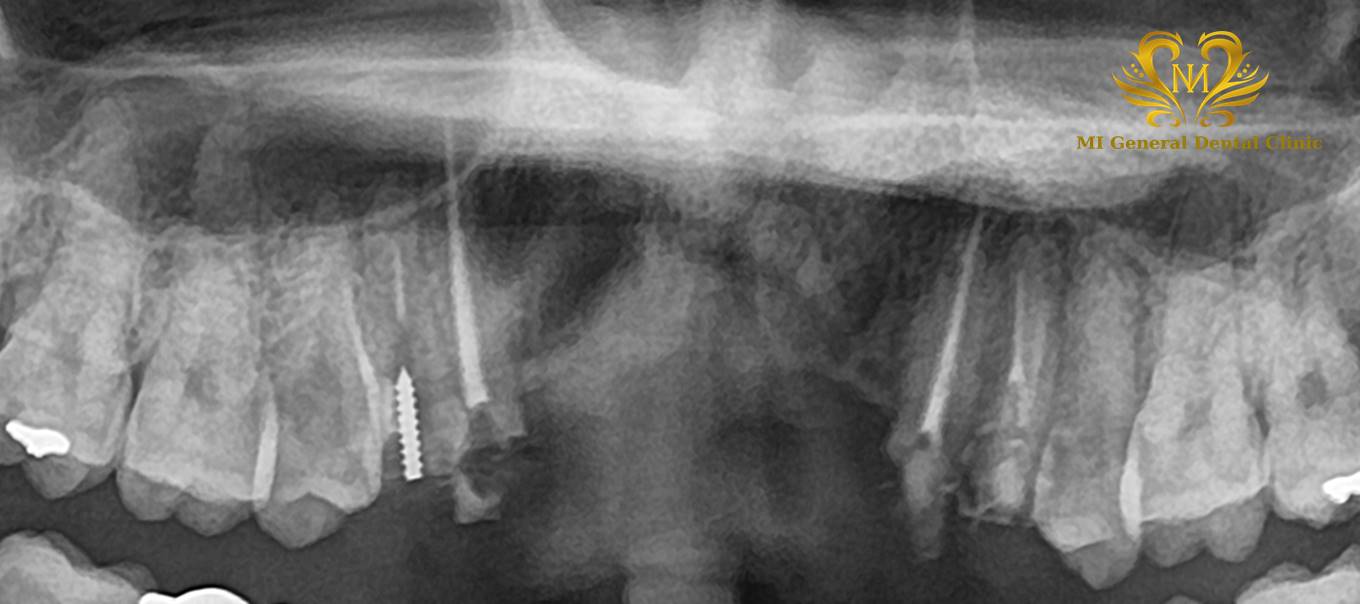 上顎前歯部のインプラント治療