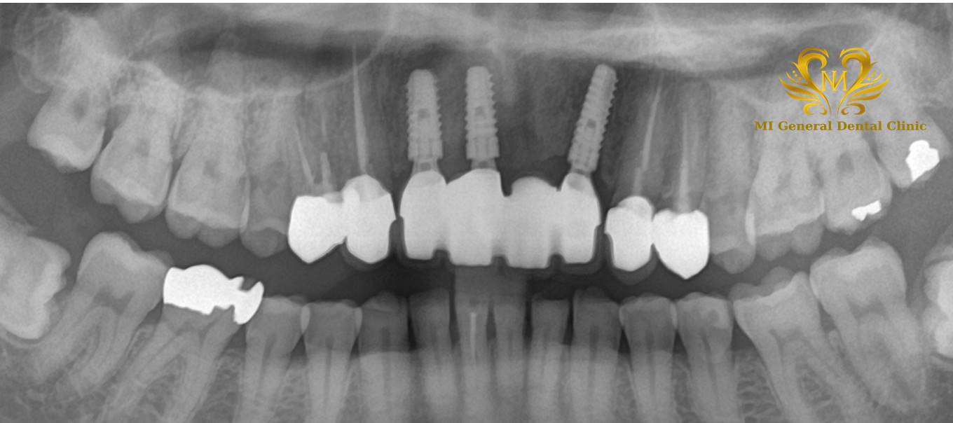 上顎前歯部のインプラント治療