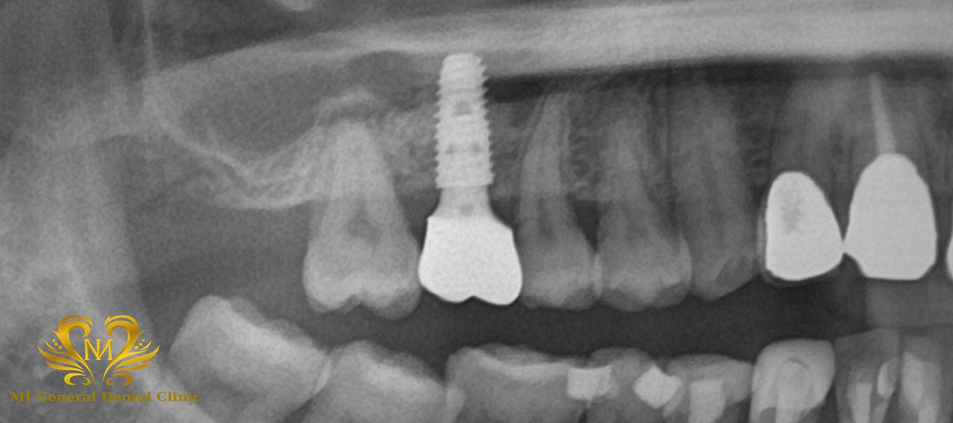 右上奥歯のインプラント治療